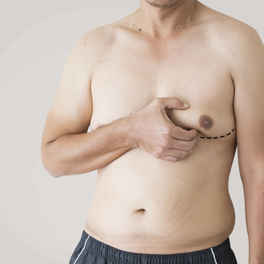 Gynecomastia