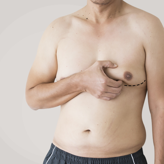 Gynecomastia Gynecomastia
