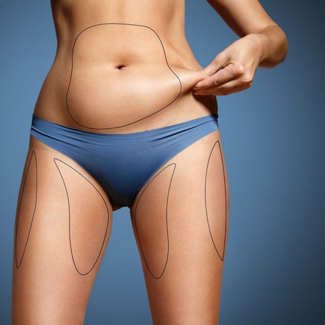 liposuction