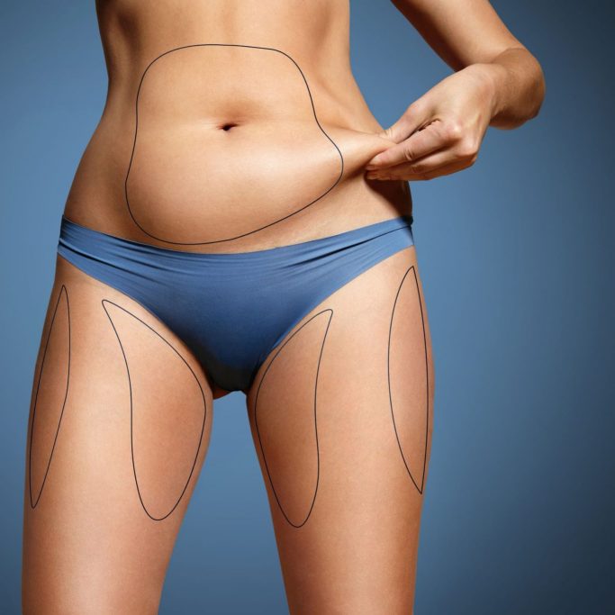 liposuction liposuction