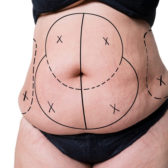tummy-tuck2 tummy-tuck2